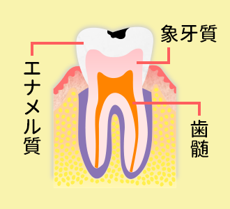 軽度のむし歯