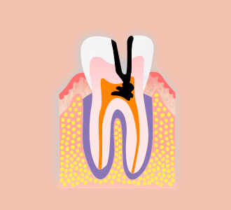 重度のむし歯