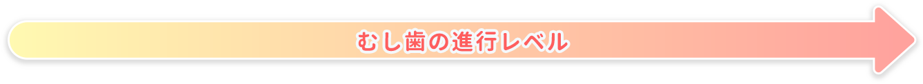 むし歯の進行レベル