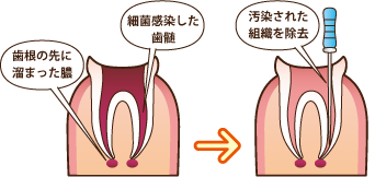 歯根の先に溜まった膿、細菌感染した歯髄を除去