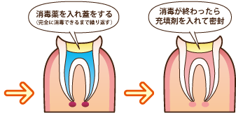 完全に消毒できるまで繰り返し、消毒液を入れ蓋をする。消毒が終わったら充鎮剤を入れて密封する